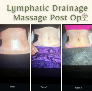 Post op lymphatic drainage 