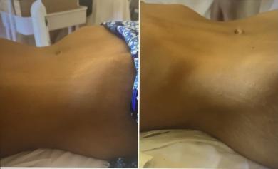 Brazilian Lymphatic Drainage and Wood Therapy